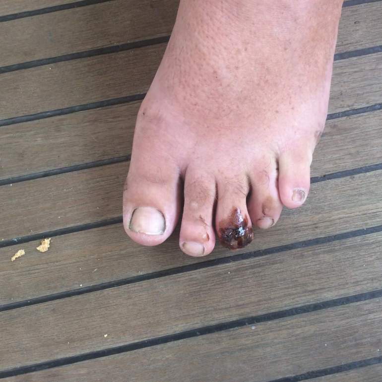 The bloody toe....it looks worse than it actually is....took a stitch out today, few more tomorrow.